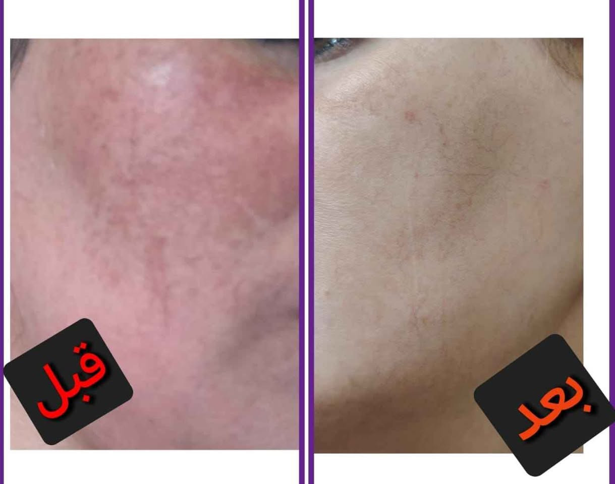 فوائد الخلطه
تفتيح لون البشرة وتوحيدها، مكافحة البقع الداكنة وعلامات الشيخوخة المبكرة، وتقشير البشرة بلطف وإزالة خلايا الجلد الميتة. كما يعمل على تهدئة البشرة وتوفيرها بالفيتامينات اللازمة للحفاظ على صحتها ونضارتها، وله خصائص تمنع ظهور حب الشباب. حلة, بابل


**إذا كنت صاحب هذا الإعلان وتريد حذفه لأي سبب، رجاءا أرسل رسالة إلى الدعم الفني**