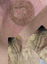 عروض بغداد الزعفرانية ليزر ازالت الشعر التاتو ازالت تاتو عروض مستمرة ا...
