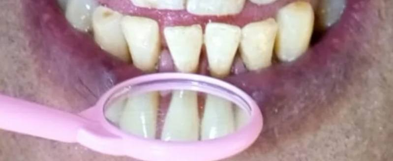 السلام عليكم المحتاج تنظيف أسنان يراسلني العلاج مجاني وتحت إشراف أطباء مختصين عيادات كلية طب الأسنان ذي قار مقابل مستشفى الحسين التعليمي يتواصل على الخاص او على رقم الواتساب ***********
