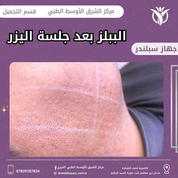 ظهور ( الببلز) بعد جلسه اليزر رد فعل طبيعي ودليل على انو الاستجابه البصيله لأشعه الليزر وان الطاقات المستخدمه مناسبه 
ولكن بالتاكيد لا يعتبر شرط اساسي لنجاح الجلسة او فشلها
وتختفي هذه فقاعات بعد فتره قصيره من الجلسه

الـعنوان : ذي قار قضاء الشطرة مدخل حي المعلمين قرب صوره الحكيم
📲للحجز والاستفسار الاتصال
 على الرقم***********
