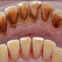 رمضان كريم عليكم اللي عنده هيج تكلسات يراسلني العلاج مجاني 07872558330