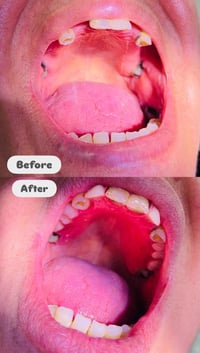 تعويض اسنان مجاني • جامعة الزهراوي • عمود ١١١١