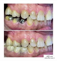 جسر زاركون  د.  جمال محمد  ماجستير صناعة وزراعة الأسنان  تدريسي في الج...