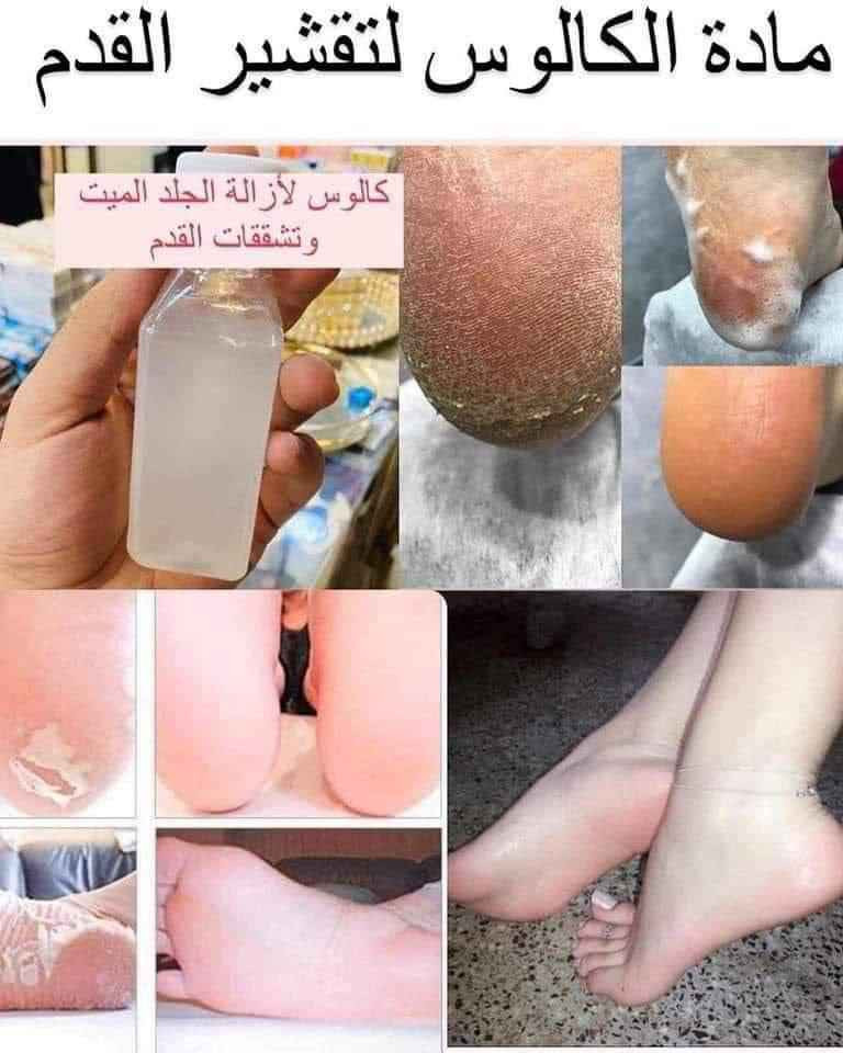 كالوس لازالة الجلد الميت و تشققات القدم
CALLUS REMOVER
ميحتاج تروحين مركز تجميل او صالون توفر منتج ( كالوس ) للقدم تگدرين تشتغليه بالبيت وبكل سهوله ♥️
وضيفته يشيل الجلد الخشن الي بالكعب خلال دقائق 👍✋
مزيل مسامير القدم - قولي وداعًا لتصلب الجلد والجلد الميت. مثل امتلاك باديكير احترافي بدون تكلفة عالية.
القضاء على الناجم في المنزل! - مزيل الجلد الميت هذا للقدمين يعمل خلال 3 إلى 5 دقائق! ببساطة انقع قدميك في حوض الاستحمام أو في حوض قدم، انتظر ثم استخدم أداة تنظيف القدم المفضلة لديك أو حجر خفاف القدم لإزالة مسامير القدم بلطف.
استخدمه مع مقشِّر قدمك المفضل - لا يقتصر على إزالة مسامير القدم فحسب، بل يجعل قدميك ناعمتين وناعمتين للطفل.

كالوس تقشير اقدام  فوري وفعلي للاقدام 
  طريقة الاستخدام:
   تغسل الاقدام بالماء  والصابون وتنقع في ماء ساخن. لمدة 5 دقائق  ومن  ثم تجفف  وتوضع قطرات من الكالوس على الجلد الخشن والتشققات وتدلك بواسطة شريحة قطنية وتترك لمدة 3 دقائق فقط وبعدها يستعمل   حجر او مبرد لازالة الجلد الميت ملاحظة يفضل استخدام قفازات بلاستيكية اثناء الاستخدام
المنشأ اماراتي اصلي 💯   
🚘 يوجد خدمة توصيل لجميع محافضات العراق بغداد, العراق


**إذا كنت صاحب هذا الإعلان وتريد حذفه لأي سبب، رجاءا أرسل رسالة إلى الدعم الفني**