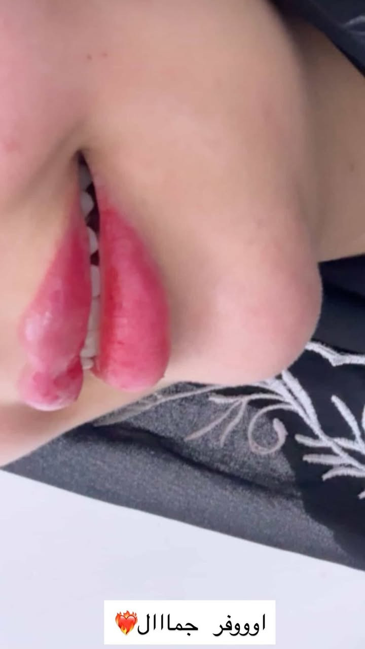 فلر شفة تعديل ع حقن سابق 🔥
من تصوير مراجعتي ✨
عرووووض شهر رمضان ثبتتهه الكم بالهايلايت بالستوري وببوست اعلى الصفحة ✨
د.ايثار سامي عبد الامير 
الكوت_الهورة_مجمع القبطان_طابق اول
الحجز***********
