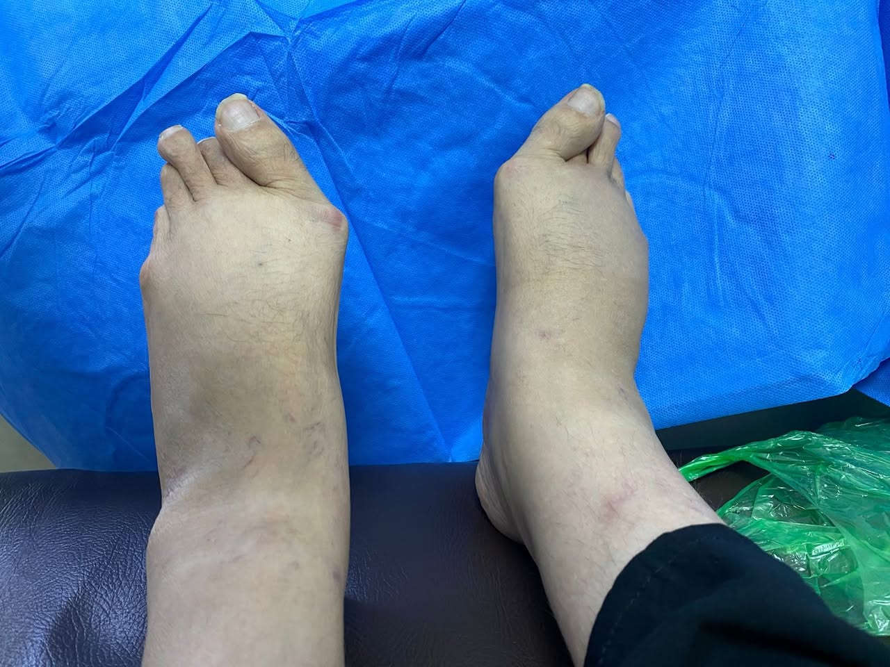 حالة اخرى من التهاب المفصل الرثوي مريضة تعاني من المرض منذ سنوات.
لكن التأخر في التشخيص والعلاج المنتظم أدى إلى:
تشوّهات واضحة في مفاصل اليدين،انحراف الأصابع تأثّر مفاصل القدمين وصعوبة بالمشي
📌 التهاب المفاصل الرثوي مرض مناعي مزمن مو مجرد ألم عابر، وإذا يُترك بدون علاج:
 → يسبب تدمير المفصل
→ يقيّد الحركة
→ يقلل جودة الحياة
✅ التشخيص المبكر
✅ العلاج الصحيح
✅ المتابعة المنتظمة
هي الأساس لمنع هذه المضاعفات.
لا تنتظر لحد ما يصير الضرر دائم.

الدكتور أحمد عباس الهلالي
بورد دكتوراه في أمراض المفاصل والروماتيزم
📍 السماوة – شارع العيادة الشعبية – عگد الجامع – خلف صيدلية لؤلؤة
📞 رقم الحجز: ***********
🔗 الحجز الإلكتروني:
https://aullan.com/d/hilali
