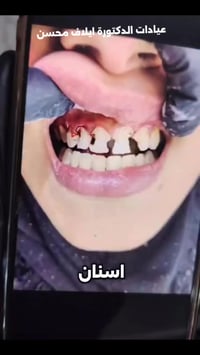 حشوات تجميلية • علاج تسوّس • عيادة د. إيلاف محسن