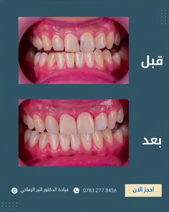 ✅تم حشوات تجميلية للأسنان الاماميه بدقه عاليه جدا للابتسامة بثقه ومظهر طبيعي 😍

(الدكتور اثیر حليم الرماحي)

للحجز والاستفسار *********** 

📍الموقع :
الديوانية- قضاء عفك/شارع الأطباء قرب صيدلية أكرم البديري بناية الدكتورة مروة حمود التميمي الطابق الثاني

#ابتسامتك_تستحق_الأفضل
 #طب_اسنان #عيادة_اسنان #دکتور_اسنان
#قضاء_عفك #حشوات_تجميلية
