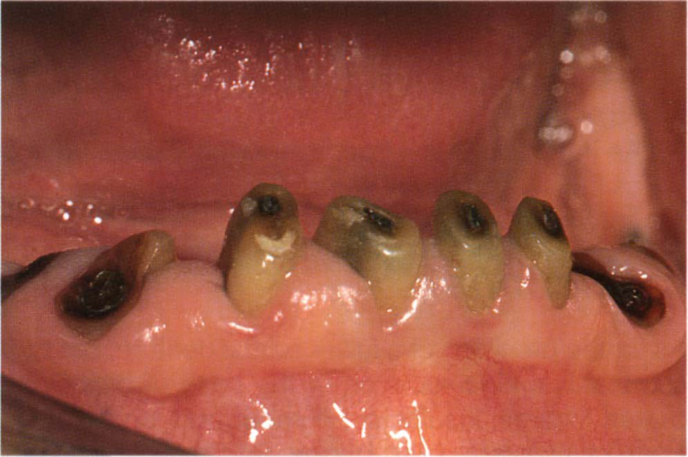 السلام عليكم يتوفر قلع بشكل مجاني📍
للاسنان المتحركه و الجذور السوداء 
للتواصل على الواتساب الرقم ***********
الموقع الكراده  شارع ٥٢ عيادات جامعه اوروك 
د.مسره
