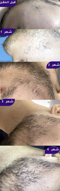 هل تعاني من فراغات في اللحية أو نمو غير متناسق؟  نوفر جلسات حقن اللحية...