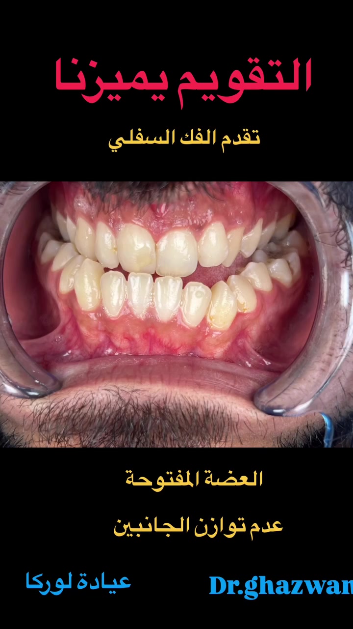 التقويم يميزنا تقدم الفك السفلي و عدم توازن الجانبين يعاني من مظهر خارجي غير متناسق عدم توازن عند الاطباق مشاكل اثناء تناول الطعام و الكلام انزعاجات اثناء النوم مضايقات اثناء التنفس و مشاكل اخرى…. علاج جميع الحالات الصعبة و المستعصية دقة علمية لكثير من الحالات خبرة طويلة اثناء ممارسة طويلة في مجال التقويم المحاولة على تقليل سقوط جهاز التقويم او نجمات تنظيف مستمر خلال الزيارات …. دكتور غزوان مزهر بغداد الكرخ نفق الشرطة بداية شارع الاطباء عيادة لوركا فوق صيدلية كنز النفق متوفر واتس *********** #تقويم_الأسنان_والفكين #تقويمالأسنان #تقويم_الأسنان_بأنواعه #تقويم_الشفاف_للأسنان #تقويم_الأسنان_قبل_وبعد @تقويم_الاسنان @تقدم_الفك_السفلي @العضة_المعكوسة @العضة_المفتوحة
