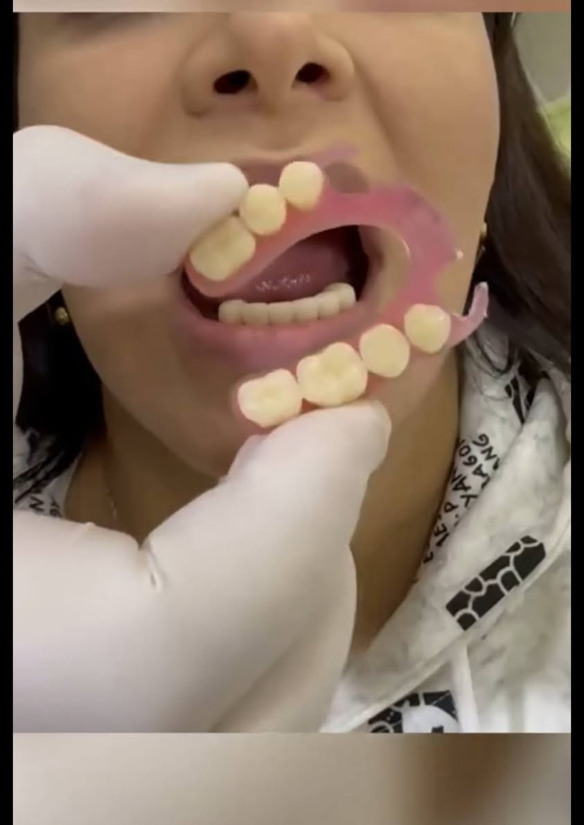 فاقد اسنانك وتريد تعوضهن؟!
بكلية طب الاسنان جامعة بابل نعوضهن الك بشكل مجاني 💸
كل الي عليك تنوي تحجز وتلتزم بالموعد 👍🏻📝
وخلال 4 جلسات راح يصير عندك طقم اسنان جاهز تلبسه بكل ايامك✨💓

احجز على الواتس ***********
او على ماسنجر الصفحة 🤝
الاربعاء ساعة 11 تنفتح العيادة
