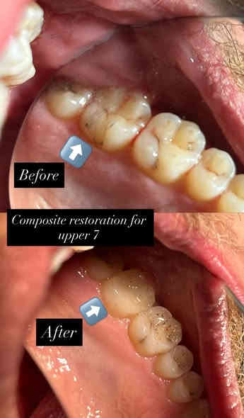 شلون حتشوفني بعيادة هملايا اذا تزورني كل
٦ اشهر كل سنة و كل سنتين و كل 4 سنين 

✨ ابتسامتك… أمانة بين أيدينا ✨
في عيادة د. (مهند السعدي) نعتني بكل تفصيلة في أسنانك، من أبسط ألم إلى أجمل ابتسامة.
✔️ حشوات تجميلية عالية الدقة
✔️ تبييض آمن بنتائج فورية
✔️ علاج عصب بأحدث الأجهزة
✔️ ابتسامة هوليود بدون مبالغة
✔️ متابعة ناعمة للأطفال
مكان واحد يجمع الراحة – التعقيم – الدقة – والنتيجة الذهبية…
نسعد بزيارتكم يومياً من الساعة 2 ظهراً و إلى ٩ ليلاً

📍 العنوان: حي المهندسين / شارع الخيمة / فوق اسواق كوب
📞 لحجز المواعيد :***********

