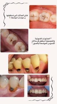 قلع / تنظيف / حشوات كومبوزدت بيضاء  / طقم جزئي وكامل / عياده معالجه اس...