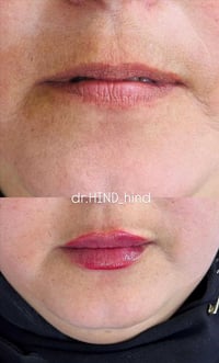 فيلر شفايف • امتلاء طبيعي • المحمودية