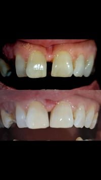 غلق الفلجة • تعويض أسنان • القياره العام