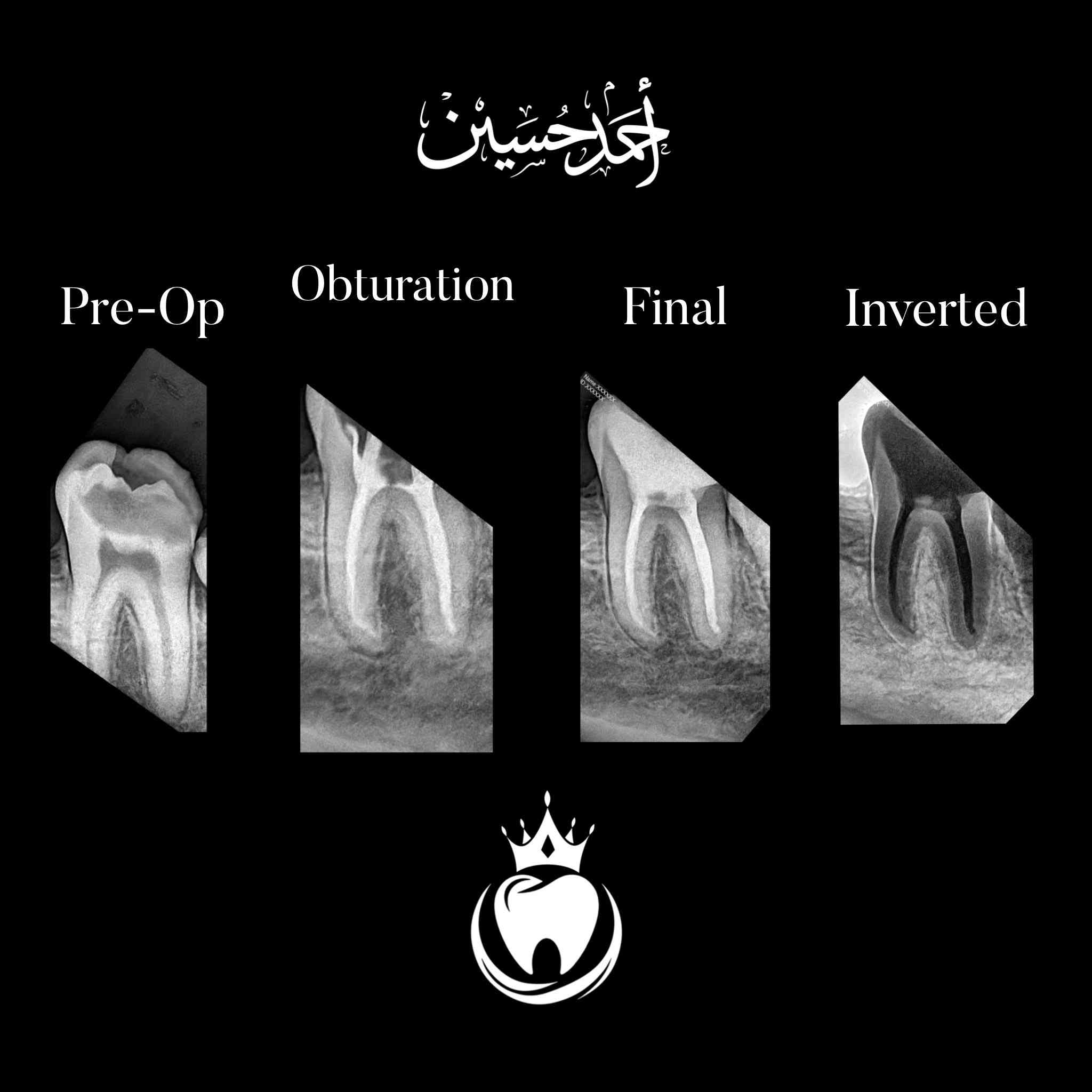 هذه الرحاة كان مصيرها القلع حسب قرار الطبيب السابق لكن قررنا نحافظ عليها كون الجزء المتبقي بعد ازالة التسوس يعتبر مناسب نوعا ما و رغبة المراجع في الحفاظ على هذا السن  و بناءََ على ذلك بدينا رحلتنا لأرجاعها الى وضعها الطبيعي😎
شرح الخطوات اسفل الصور 

الدكتور احمد حسين الطعماوي 
ناحية الزاب - المجمع الطبي الحديث مجاور مرطبات كرزة
الدوام طيلة ايام الاسبوع من الساعة ٣:٣٠ الى الساعة ٨:٠٠ مساءا
للحجز و الاستفسار : ***********
