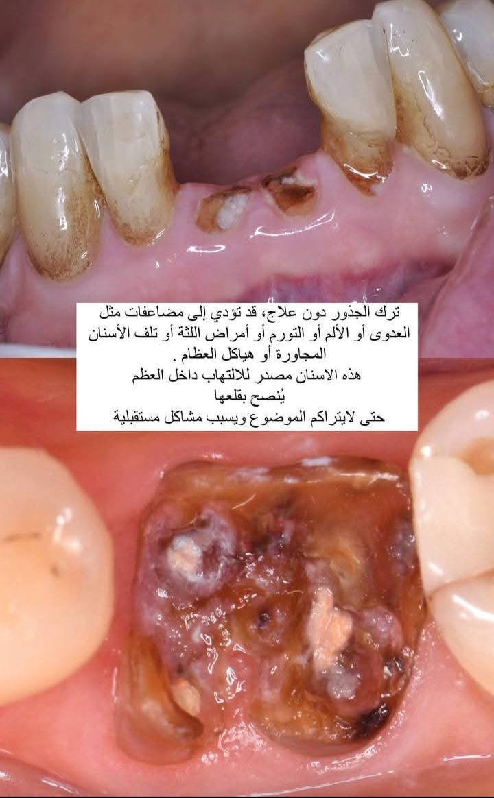 السلام عليكم 
اللي يحتاج علاج يخص أسنان الأطفال
(فحص، تنظيف، حشوات، قلع أسنان لبنية، تطبيق مادة الفلورايد للحماية من التسوس ، علاج آلام الأسنان، والمتابعة الدورية)
يتواصل وياية حتى أحجز له موعد
📍 في المستشفى التعليمي – جامعة الكوفة
📩 للتواصل عبر حساب الفيسبوك
📱 أو واتس آب: ***********
