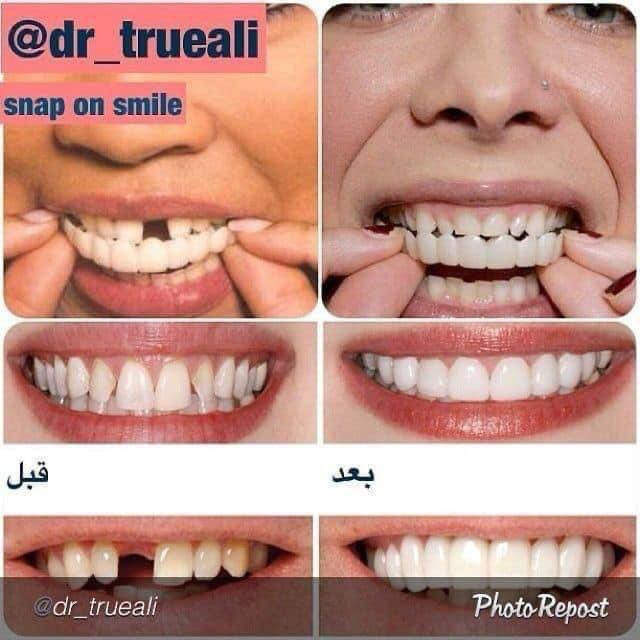 طقم اسنان  snapon smile
snapon smile شلون تتركب كم مده
تبقى.......الخ

شوفو حبايبي 💋بالبدايه تنضفون اسنانكم واول شي تخلون السيلكون بماء حار
((تجي وي كل فك سلكونه عباره عن ماده جيلاتينيه صلبه)) ‼️
وتخلو ع الاسنان بعده تلبسون الفك راح يتخذ الحجم المناسب للاسنان استخدامه كوولشي سهل طبعا يستخدم للمناسبات او الايام العاديه كولش مناسب وسهل وينطي مضهر حلو

🦷عادي تفرشو بمعجون وفرشه 😅
🦷عادي تاكلون بي وابد ميتلون  سواء شربتو شاي او قهوه ....
🦷عادي تنامون بي ...
🦷عادي تلبسو 24 ساعه ..
🦷عادي تشيلو وترجعون تلبسو مره ثانيه.
🦷كوولش طبيعي ....
🦷مناسب لكافه الاعمار ...
🦷مصنوع من ماده السيليكون القوووي
يبقى طول العمر طبعا بعد متشيلي تحفظي بالعلبه الخاصه بي

🚘يوجد خدمة توصيل لجميع محافظات العراق ٤ الاف🚘


**إذا كنت صاحب هذا الإعلان وتريد حذفه لأي سبب، رجاءا أرسل رسالة إلى الدعم الفني**
