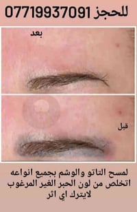 للمسح التاتو وللوشم بجميع انواعه اتخلص من لون الحبر الغير المرغوب لايت...