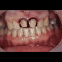 زراعة أسنان • تجميل أسنان • خانقين تولة فروش