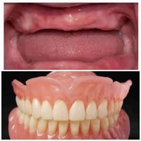 اي شخص يعاني من فقدان كامل للاسنان يراسلنا خاص او على الرقم 0771444493...