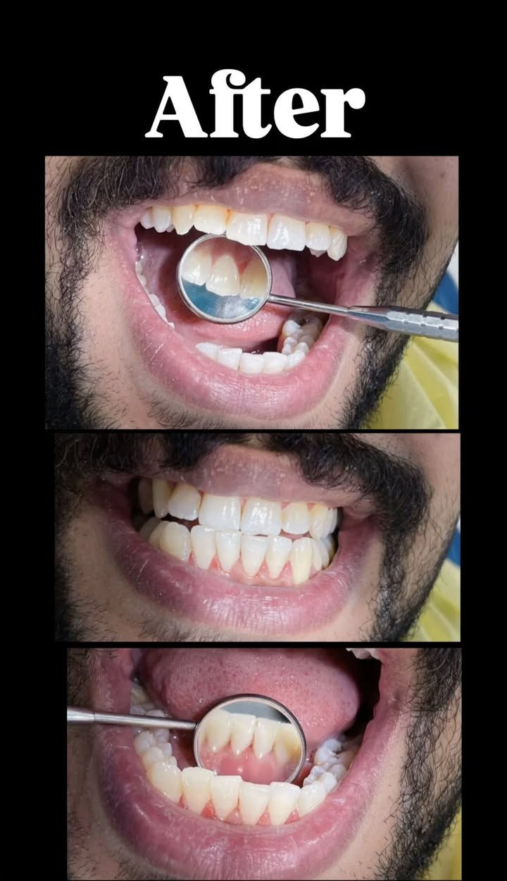 🦷 علاج أسنان مجاني 100%! لفترة محدودة ⏳

#حشوات تجميلية بجلسة واحدة  
#تنظيف اسنان | #قلع الاسنان والجذور التالفه | #تقويم اسنان   
#تعويض أسنان (فك كامل أو فكين)  
علاج مشاكل أسنان #الأطفال بالكامل👶  

👩‍⚕️ بإشراف أطباء اختصاص  ✨ أجهزة وتقنيات حديثة  

📍 #شارع 40 – مجاور صيدلية سلامتك أولاً  

📲 واتساب: ***********  

📸 الصور نماذج من شغلنا
