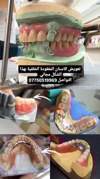 طقم اسنان مجاني • كلية طب الاسنان • ٤ جلسات