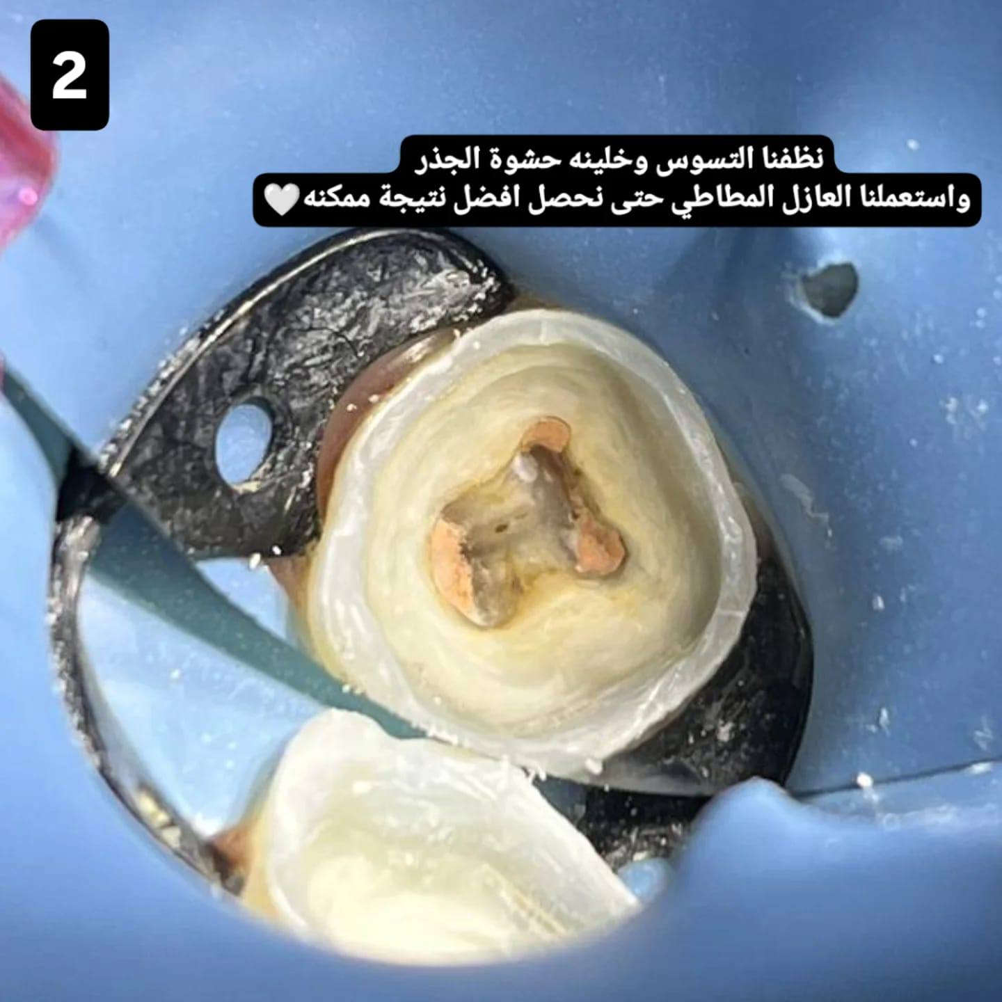 حشوة جذر واعادة ترميم شكل السن

المكان/ حي 17 الشارع العام لمكتبة المهندس مجاور لمدرسة المشاعل

للحجز والاستفسار/ ***********
