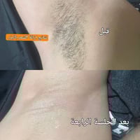 ليزر منزلي • تقنية IPL • ٥٠٠ألف ومضة