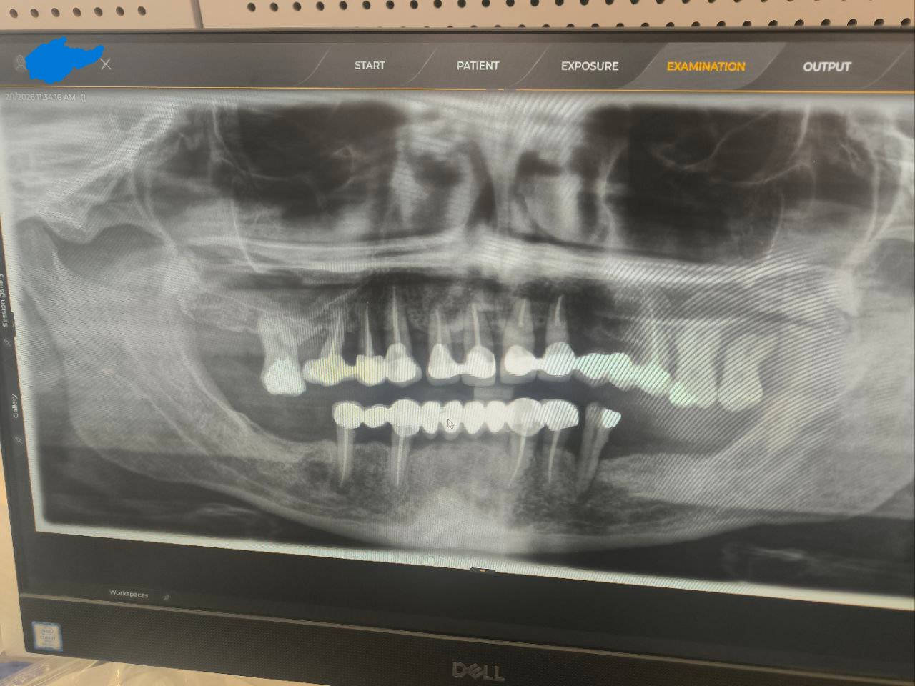 🦷 فرصة علاج الأسنان في عيادات الجامعة الأمريكية في بغداد
العلاج يتم تحت إشراف أطباء اختصاص وضمن نظام تشخيص أكاديمي دقيق.
✔️ حشوات تجميلية
✔️ تنظيف أسنان
✔️ علاج جذور
✔️ تراكيب سنية
✔️ فحص وتشخيص كامل
💰 العلاج مجاني
📍 الموقع: الجامعة الأمريكية في بغداد – شارع المطار
📞 للحجز والاستفسار (واتساب): ***********
⚠️ الإعلان لغرض تنسيق المواعيد ولا يمثل جهة رسمية تابعة للجامعة.
صور الجامعة من auib_shine
