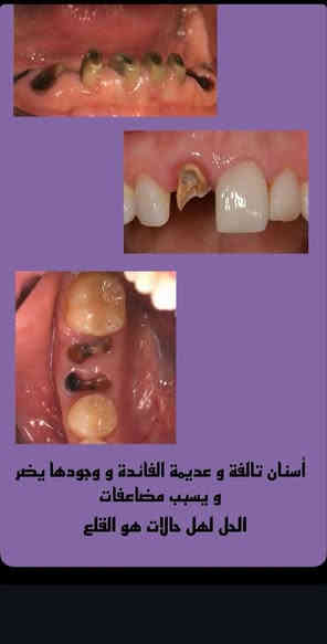 قلع الأسنان والجذور التالفة
• تنظيف الأسنان وإزالة التصبغات

• معالجة الأسنان بالحشوات الضوئية التجميلية

• تعويض الأسنان المفقوده ( طقم اسنان  ) 

✨ بإشراف نخبة من الأطباء المختصين

وباستخدام أحدث الأجهزة والمواد

لضمان أفضل النتائج ✨

(مجاني)

📞 للتواصل:   *********** 

📩 

📍 الموقع: كربلاء |  طريق النجف  |  جامعة الزهراوي
