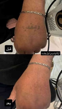 إزالة وشم • عيادة سنايا • كربلاء الجمعية