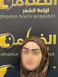 زراعة الحاجب • تقنية الشريحة • كربلاء