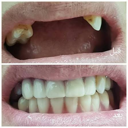 📛مجانا📛
عيادات البيارق تعلن عن خدمة طبية متكاملة وبشكل (مجاني بالكامل)
-قلع الأسنان المتضررة وبقايا الجذور-
-حشوات الأسنان المتسوسة-
-تعويض الأسنان المفقودة-
-تنظيف تكلسات الأسنان-
🔴سارعوا بالحجز🔴
للاستفسار والحجز الاتصال على الرقم
***********
او مراسلة الحساب _drmu_
