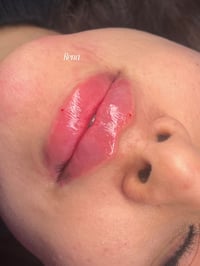 فيلر شفة • عيادة تجميل • مجمع علم الكندي