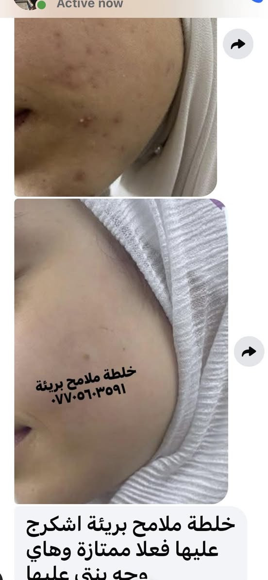 شمنتضرة ؟؟عالجي بشرتج 🥰
سارعي بالحجز 😘
وبرزي جمالج وملامحج الطبيعية ببشرة  خاليا من التصبغات والكلف والنمش والتجاعيد والحبوب وآثار الحبوب 🌹


**إذا كنت صاحب هذا الإعلان وتريد حذفه لأي سبب، رجاءا أرسل رسالة إلى الدعم الفني**