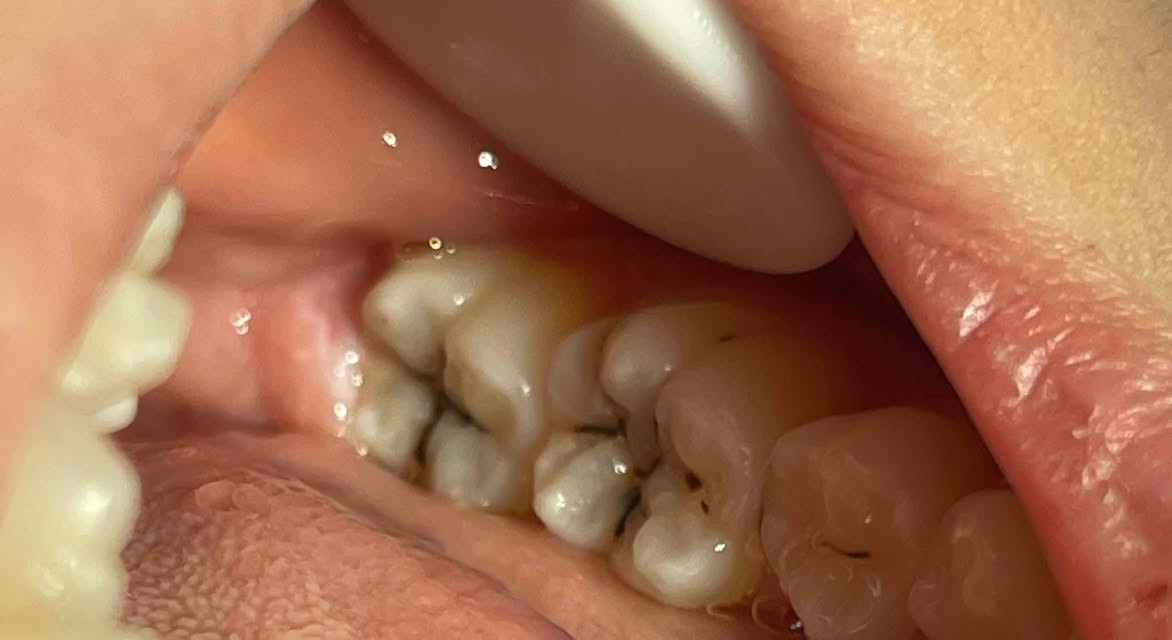 📍🦷📍
نعالج في عيادات جامعةالهادي 

- قلع الاسنان والجذور التالفة
- تنظيف الاسنان من التصبغات والتكلسات
- حشوات تجميلية للاطفال والكبار 
- تعويض الاسنان بطقم كامل متحرك 

ان كنت تعاني من احد هذه المشاكل☝🏼يمكنك التواصل معي عن طريق المراسلة في الخاص او الرقم ***********
-الموقع الدورة نهاية شارع ستين -(قرب كنيسةبولص وبطرس) قرب 

(علماً ان العلاج مجاني بشكل كامل وبأشراف اطباء مختصين)
