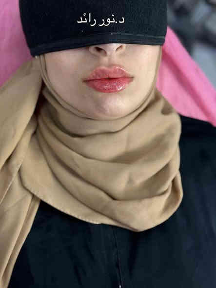 رسمت ب اتقان وحب ب ايادي د.نور رائد @dr.noor_raid 
عروضنا مستمرة استغلوها 
📍📍عيادة بيرلي (نبتون)
الحمزة الشرقي جهة شارع الملاحة مقابيل صيدلية نجلاء الشيباني 
واتساب او الاستفسار ***********
#الحمزة_الشرقي #عيادة_بيرلي_نبتون #شفة
