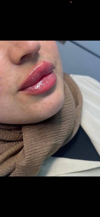 فلر سي كامل • نتائج طبيعية • رتوش مجاني