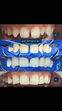 تجميل الأسنان • تعويض الأسنان • القياره العام
