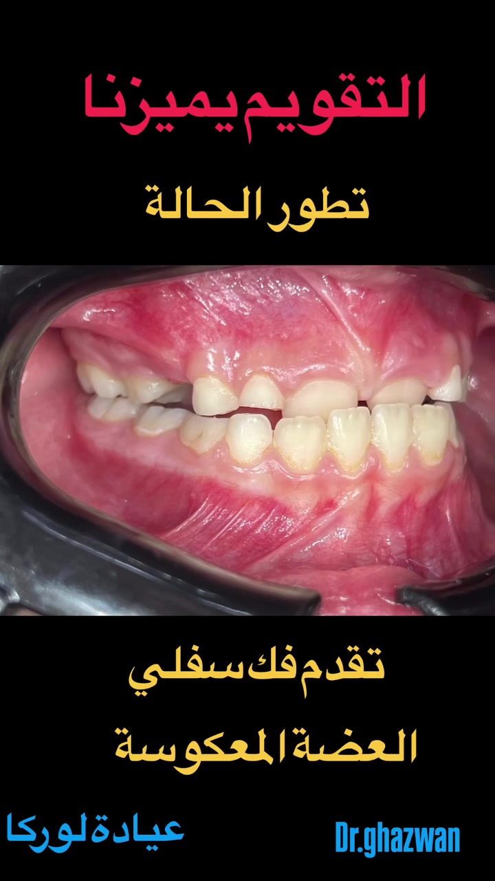 التقويم يميزنا احد اعقد و اصعب للحالات تقدم الفك السفلي ماشاءالله النتائج واضحة الوصول الى مراحل متقدمة مستمرين حتى النتائج النهائية…. علاج جميع الحالات المعقدة و الصعبة بالطرق العلمية و الخبرة المتمكنة نتائج مثالية اسعار مناسبة بالتقسيط المريح الكفاءة الطبية و التجميلية للاسنان … دكتور غزوان مزهر بغداد الكرخ نفق الشرطة بداية شارع الاطباء عيادة لوركا فوق صيدلية كنز النفق متوفر واتس *********** #تقويم_الأسنان_والفكين #تقويمالأسنان #تقويم_الأسنان_بأنواعه #تقويم_الشفاف_للأسنان #تقويم_الأسنان_قبل_وبعد @تقويم_الاسنان @تقدم_الفك_السفلي @العضة_المعكوسة
