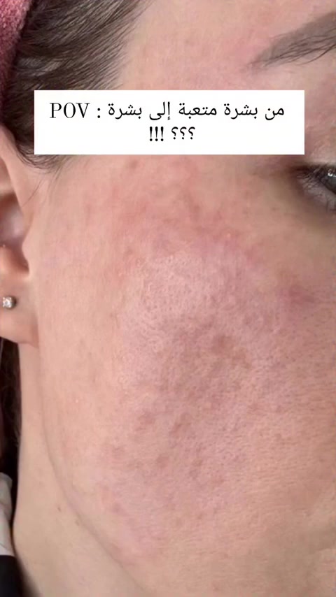 كريم مرمم سيكابلاست B5 بلس من لاروش بوزيه 💜🍓
💜 واحد من أشهر المنتجات الطبية التي أطلقتها الشركة الفرنسية من لاروش بوزيه 

ملطف ومرطب للبشرة 🍓
تقوية حاجز البشرة 🍓
مرمم قوي خاصة بعد التقشير 🍓
بيخفي أثار اي ندوب حب الشباب 🍓
بيقلل من الخطوط التعبيرية ما بيخفيها 
نضارة بشرة رائعة 🍓

💜 منتج رائع بنتائج رهيبة 
صنع في فرنسا

#يوجد_توصيل_لكافه_المحافظات


**إذا كنت صاحب هذا الإعلان وتريد حذفه لأي سبب، رجاءا أرسل رسالة إلى الدعم الفني**