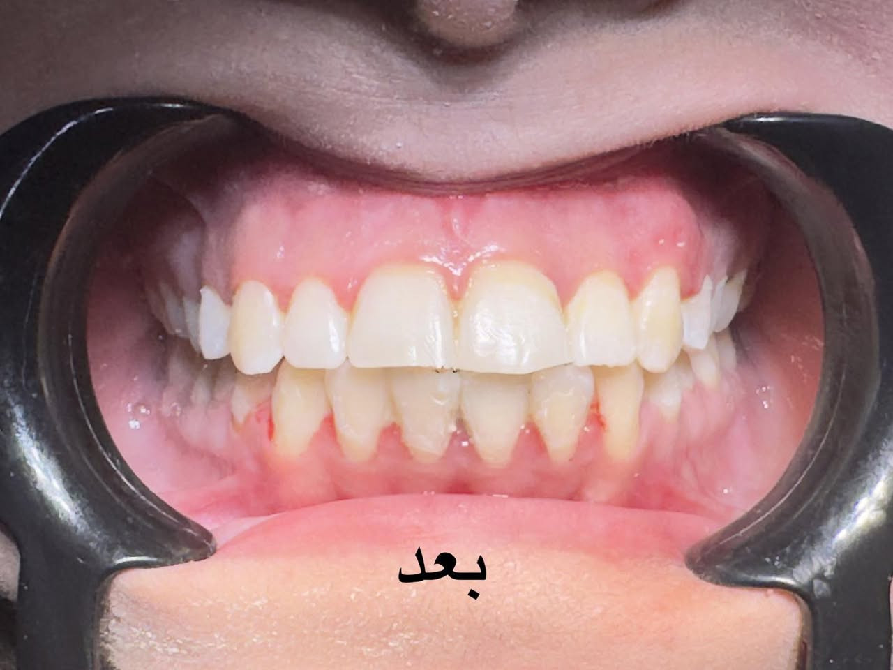 رفع التقويم بعد ترتيب وتعديل الاسنان للفكين
طبيب الاسنان الاختصاص د.عمار عباس
ماجستير تقويم وتجميل الاسنان M.S.c ortho
بكلوريوس طب وجراحة الفم والأسنان B.D.S
بغداد الشعب شارع عدن قرب  مركز شرطة الشعب  مدخل سوق شلال عمارة باريس الطابق الاول دوام العيادة جميع ايام الاسبوع ما عدا الجمعة عطلة من ٤ ل ٨  بدون حجز مسبق الدخول حسب اسبقية الحضور للعيادة الفحص والمعاينة مجاني للاستفسار ***********

