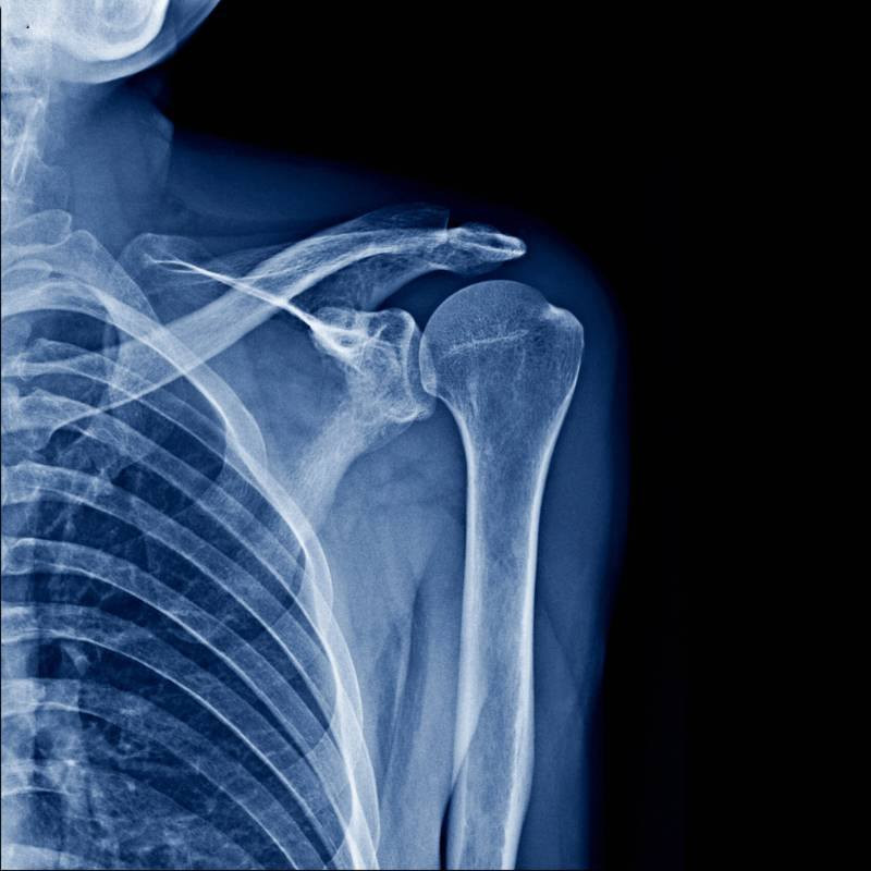 🎯 عند حدوث اصابة في الكتف لاتترك الحادث بدون تشخيص دقيق!
تلعب الأشعة الرقمية DR دور مهم وأساسي في كشف وتشخيص إصابات الكتف بسرعة ووضوح عالي، حتى تساعد الطبيب  في تحديد العلاج المناسب بأقصر وقت 💡
الاشعة الرقمية  DR:-
🔹 تكشف الكسور والخلوع بدقة عالية.
🔹 تساعد بتشخيص التهابات المفاصل والتكلسات.
🔹 تبين مشاكل الأوتار والمفصل بعد السقوط أو الحوادث.
🔹 صور فورية بجودة ممتازة وجرعة إشعاع أقل.
🔹 وقت اقصر لأخذ الاشعة و والتشخيص الدقيق.
♦️ في عيادة العامل للأشعة الرقمية DR
نوفر تصوير رقمي حديث بإشراف كادر متمرس و مختص  واهتمام براحة المراجع 👨‍⚕️✨
📍إذا عندك ألم، سقوط، أو صعوبة بحركة الكتف… لا تهمل التشخيص المبكر.
#عيادة_العامل
#الأشعة_الرقمية
صحتكم.. اهتمامنا
متواجدين طيلة ايام الاسبوع مع يوم الجمعة من الساعة(4-8) مساءً بوجود كادر نسائي متمرس والعيادة طابق ارضي
حي العامل.. السوق الشعبي.. شارع الأطباء.. مجاور صياغة الزيدي.. مقابل مكتب السيد الشهيد محمد صادق الصدر (قدس سره) 
للاستفسار الاتصال على الرقم :***********

