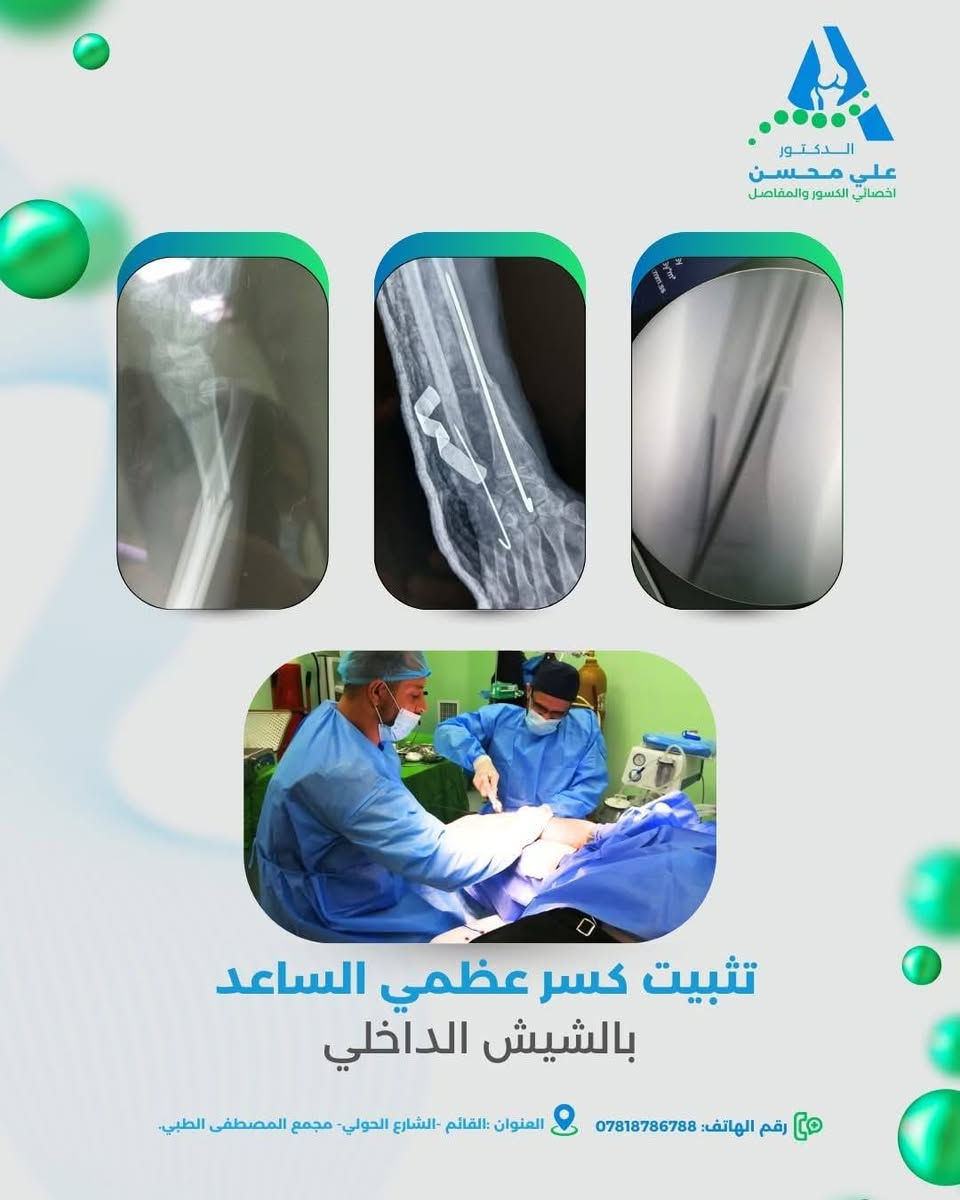 يتواجد اعتبار من يوم غد الجمعة  👨‍⚕️  #الدكتور_علي_محسن_حسين
اختصاص جراحة العظام والمفاصل والكسور
للمراجعة الاستشارية 
يتميز الدكتو بحصيلة علمية متميزة في:
🔹 تشخيص وعلاج آلام المفاصل والأمراض الروماتيزمية
🔹 تدبير حالات هشاشة العظام والتشوهات العظمية لدى مرضى الأطفال
🔹 التعامل مع الإصابات الرضية والكسور بمختلف درجات التعقيد

 فرصتك للمراجعة مع أبرز الاختصاصيين في مجال جراحة العظام على مستوى العراق.

📍 موقع العيادة: القائم – الشارع الحولي – مجمع المصطفى الطبي
☎️ لتأكيد المواعيد: ***********

#رعاية_طبية_متميزة #جراحة_العظام #استشارة_عظمية #طب_العراق #القائم_الطبية
#دكتور_عظام #استشارة_عظمية #جراحة_المفاصل #علاج_الكسور #صحة_عظامك #القائم #العراق_الطبي
