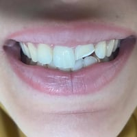 حشو تجميلي • علاج سن مكسور • فرع حي النصر