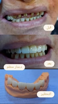 🌟 تركيبات الزيركون… الحل الأمثل لتعويض الأسنان 🌟 إذا كنت تعاني من أسنا...