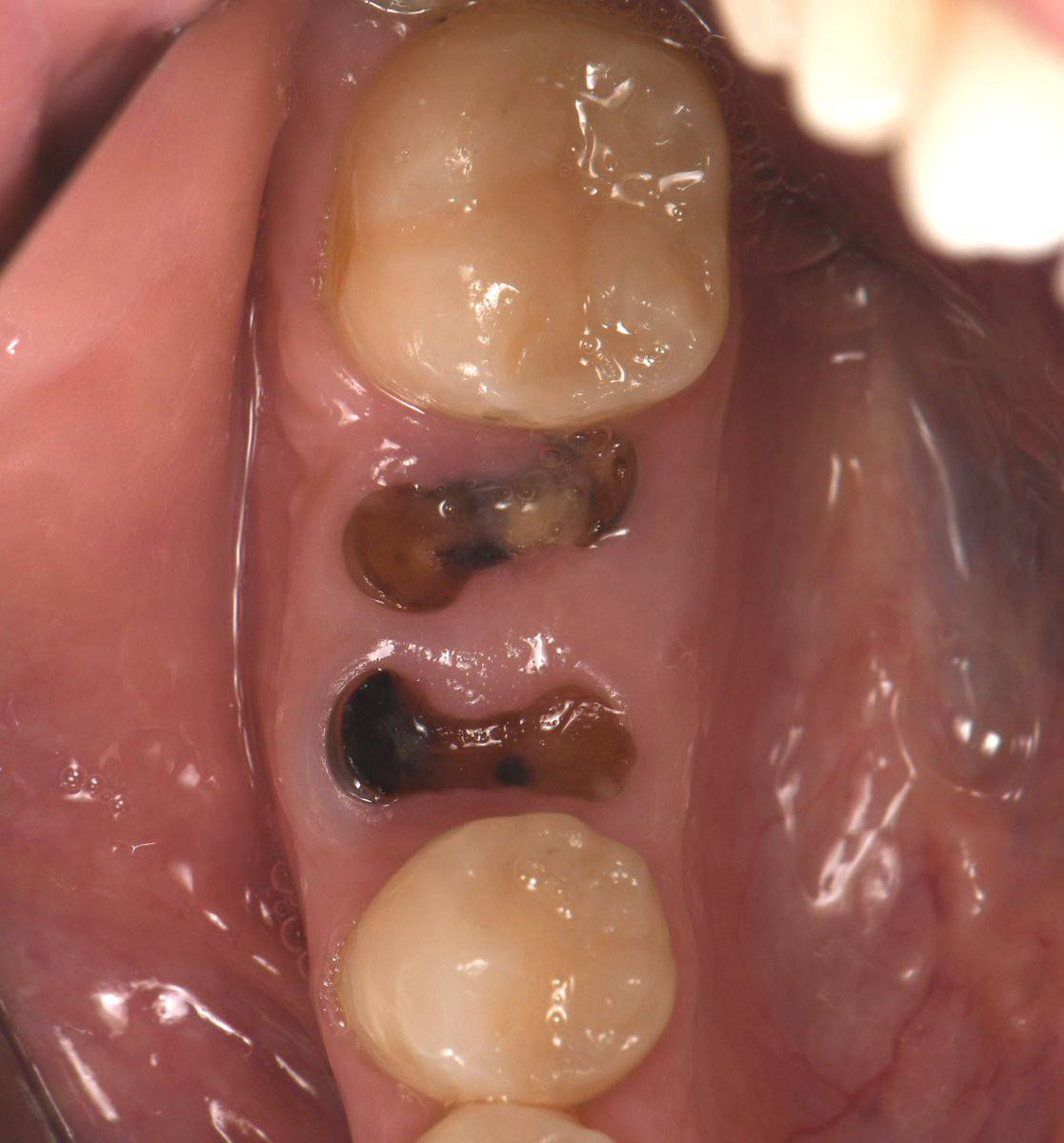 مجانا.
قلع الاسنان التالفه والجذور المتبقيه
حشوات ضوئيه تجميليه 
تنضيف الاسنان 
طقم اسنان متحرك جزئي
علما ان العلاج مجاني 
للتواصل الاتصال على الرقم التالي او التواصل على الواتساب ***********

