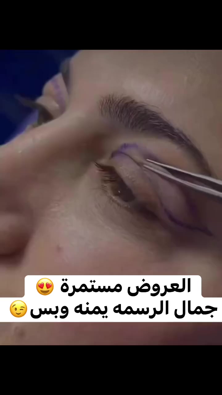 عروض العيد المميزة

عروض خاصة على قـٓ 😍ـص الأجفان  
وتحسين مظهر الجفن بالليزر.

إجراء يهدف إلى إبراز جمال العين  
وإعطاء مظهر أكثر حيوية.

بإشراف:  
الدكتور أحمد أسامة  
الدكتور حيدر الحداد  

العرض لفترة محدودة
***********
 #تفاعل #تجميل #العراق  #fightcoronavirus
